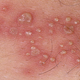 Illustration for article titled Obat Herpes Paling Manjur